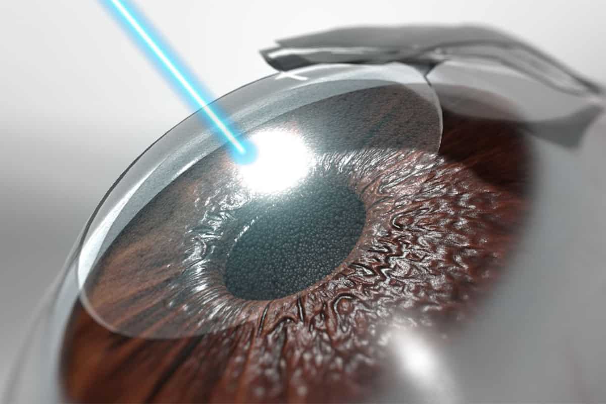 Cirurgia Refrativa 100% a laser